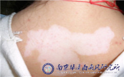 稳定期白癜风症状是什么
