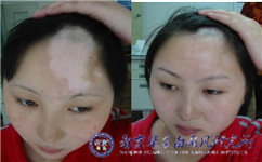 哪里治疗白癜风效果好