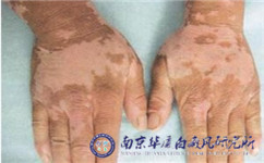 白癜风是传染病吗