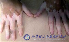 白癜风的危害有哪些
