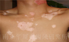 白癜风哪个阶段最容易扩散