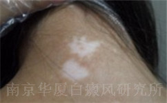 南京白癜风治疗哪家好