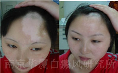 女性白癜风患者注意哪些