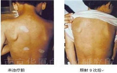 白癜风能完全治愈吗