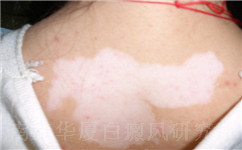 白癜风传统治疗有哪些不足