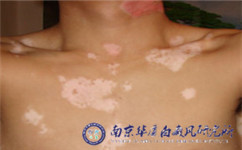 白癜风初期是什么症状