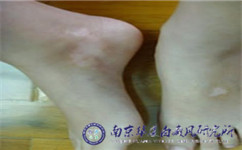 南京哪家医院可以治愈白癜风