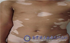 南京哪里治疗白癜风比较好