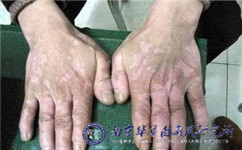南京什么医院可以治白癜风