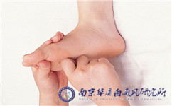 南京看白癜风哪家医院最好